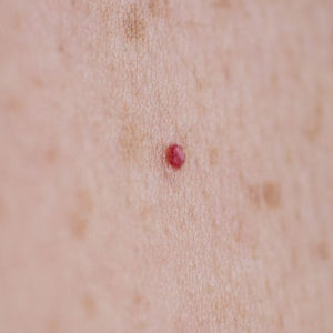 Angioma-img-2 | Dermatology Clinic of Iowa