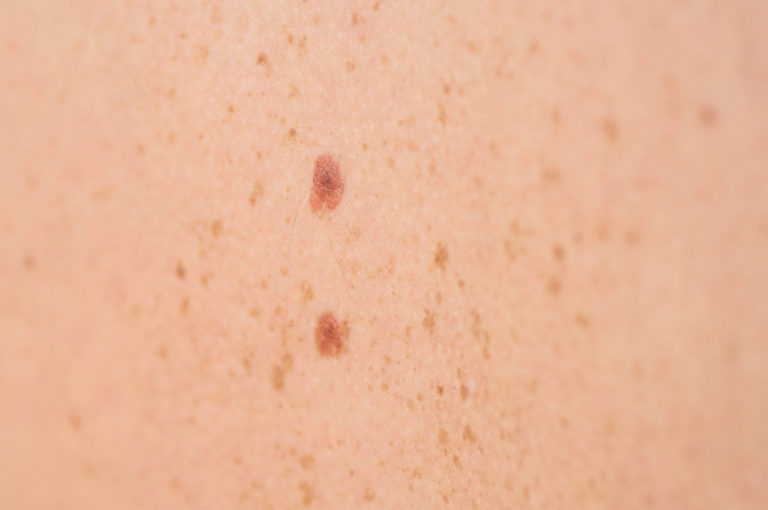 Squamous Cell Carcinoma (SCC) | Dermatology Clinic of Iowa